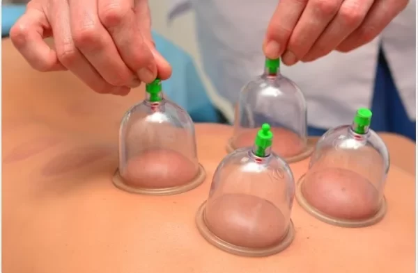Cupping_therapy_shutterstock_184799273